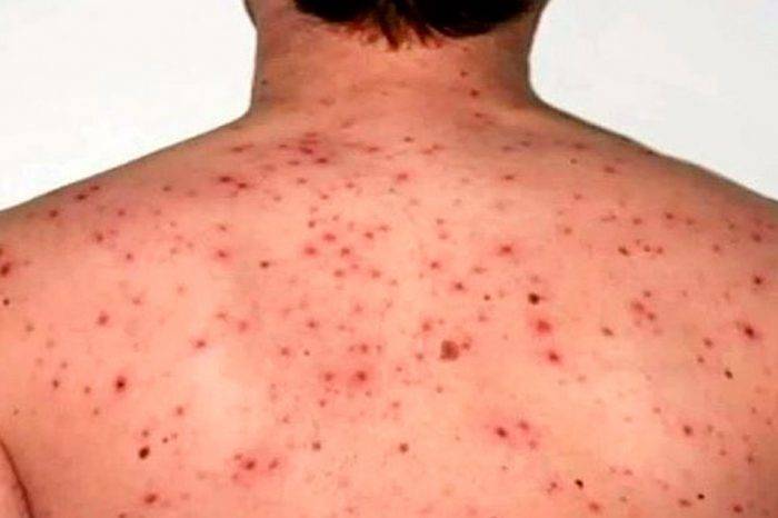 Sarampión. Foto:Doc Salud