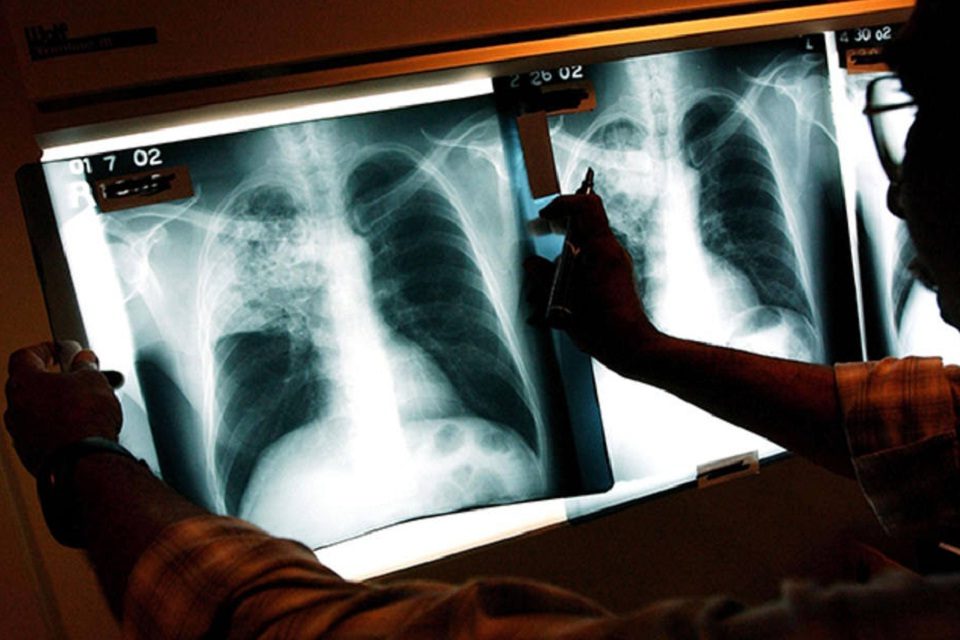 Tuberculosis ANM