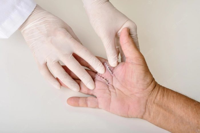 Mano ortopedico infantil cirugia